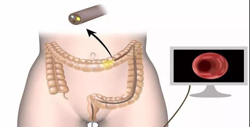 科普｜结直肠癌50岁后高发，给自己一个中年礼物“肠镜检查”